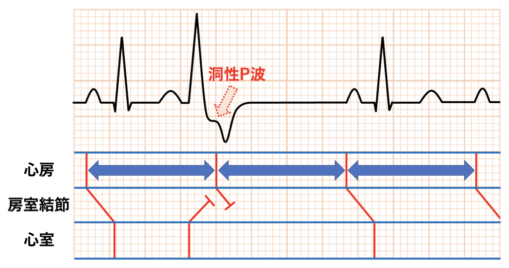 完全代償性休止期(fully compensatory pause)