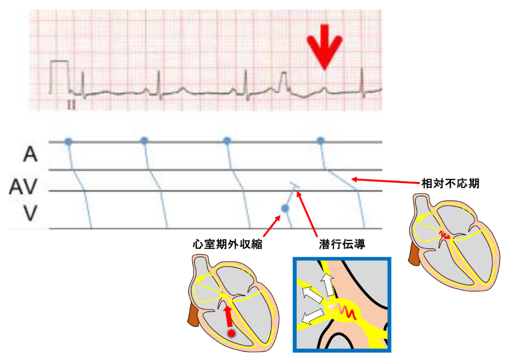 潜行伝導(concealed conduction)
