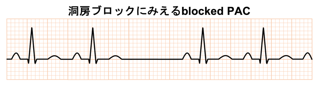非伝導性心房期外収縮(blocked PAC)
