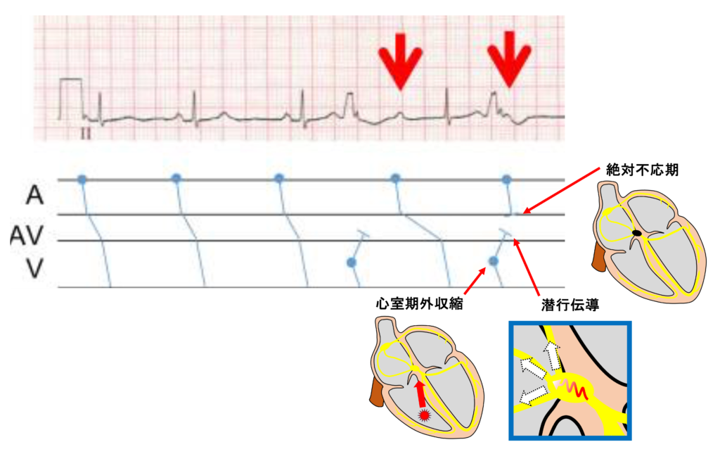 潜行伝導(concealed conduction)