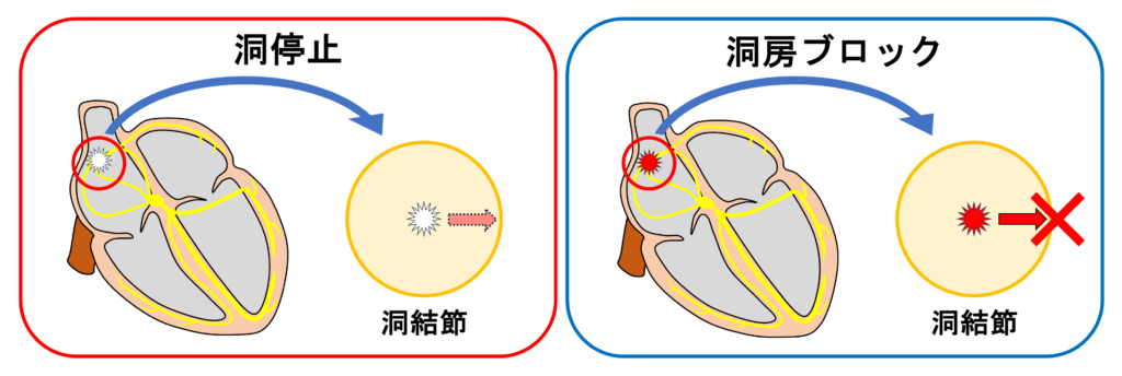 洞停止(sinus arrest)