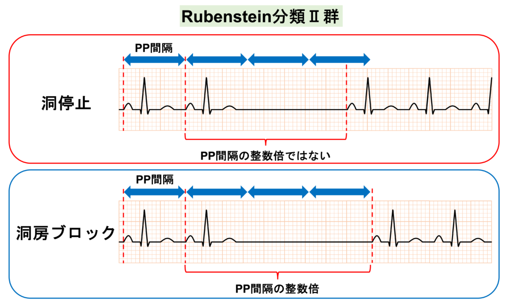 洞停止(sinus arrest)