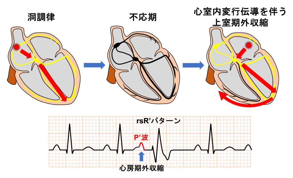 上室期外収縮(Supraventricular premature contraction：SVC)