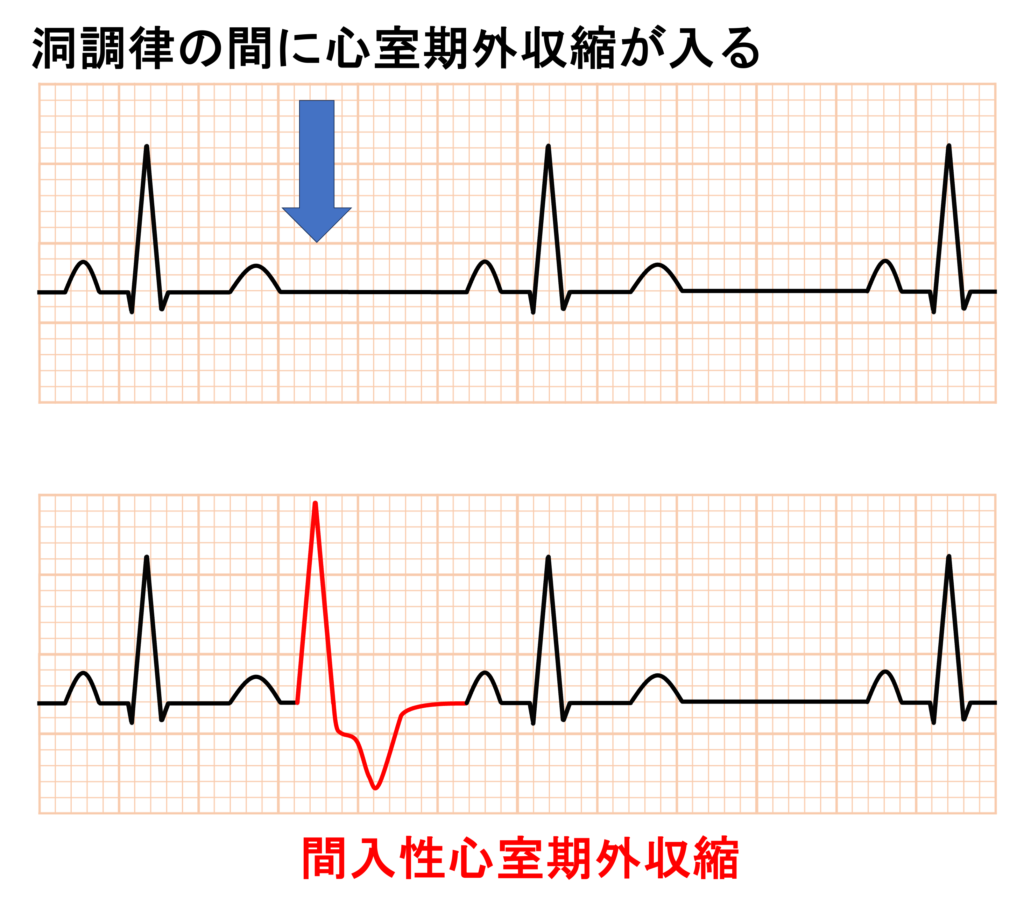 間入性心室期外収縮(interpolated premature ventricular contraction)