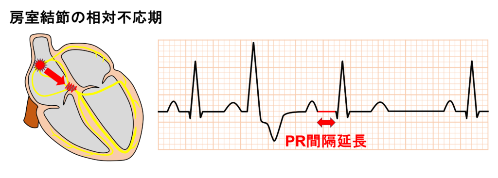 間入性心室期外収縮(interpolated premature ventricular contraction)