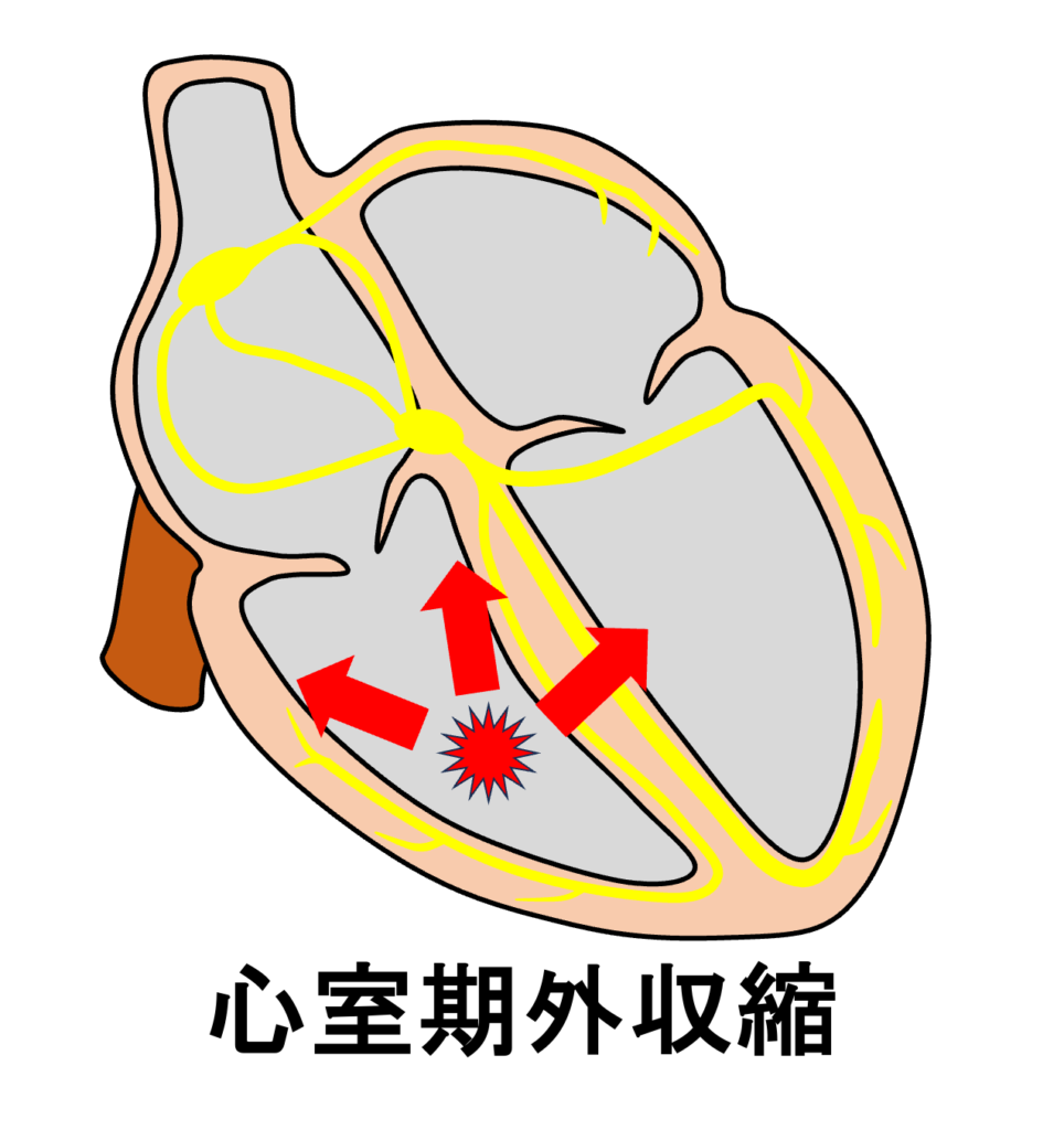 心室期外収縮(Premature Venticular Contraction：PVC)