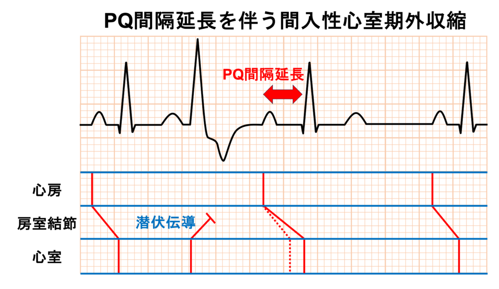 心室期外収縮(Premature Venticular Contraction：PVC)