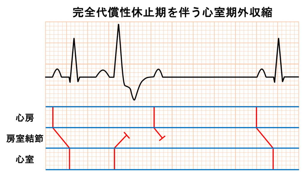心室期外収縮(Premature Venticular Contraction：PVC)