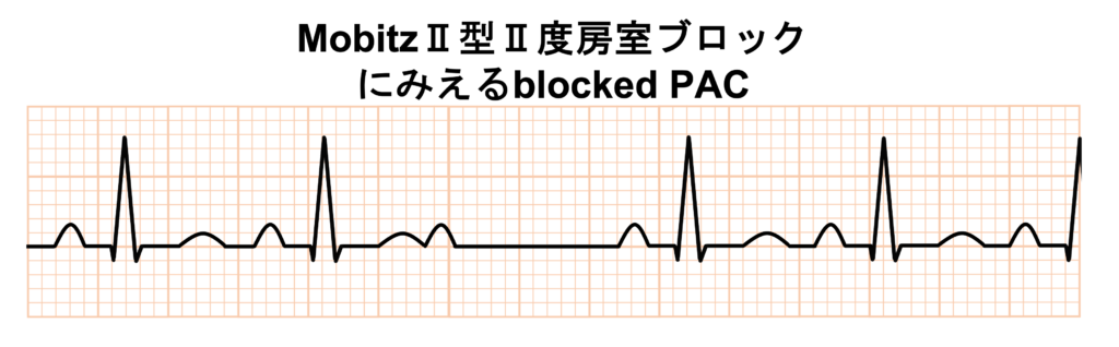 非伝導性心房期外収縮(blocked PAC)