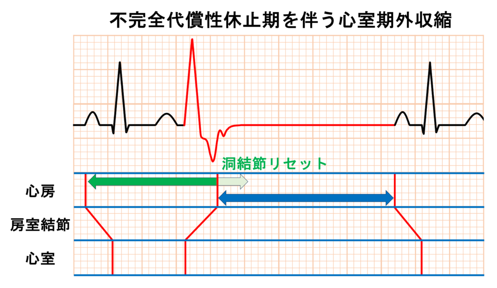 心室期外収縮(Premature Venticular Contraction：PVC)