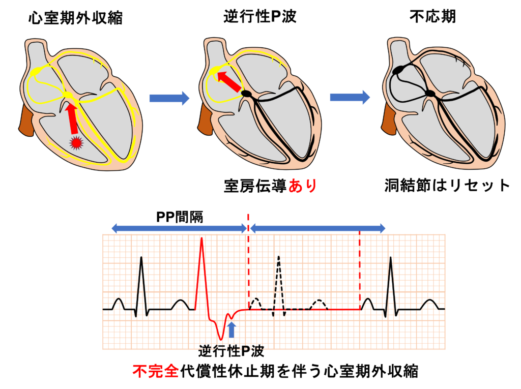 不完全代償性休止期(not fully compensatory pause)