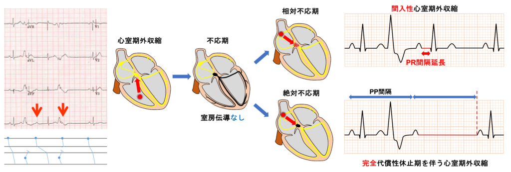 潜行伝導(concealed conduction)