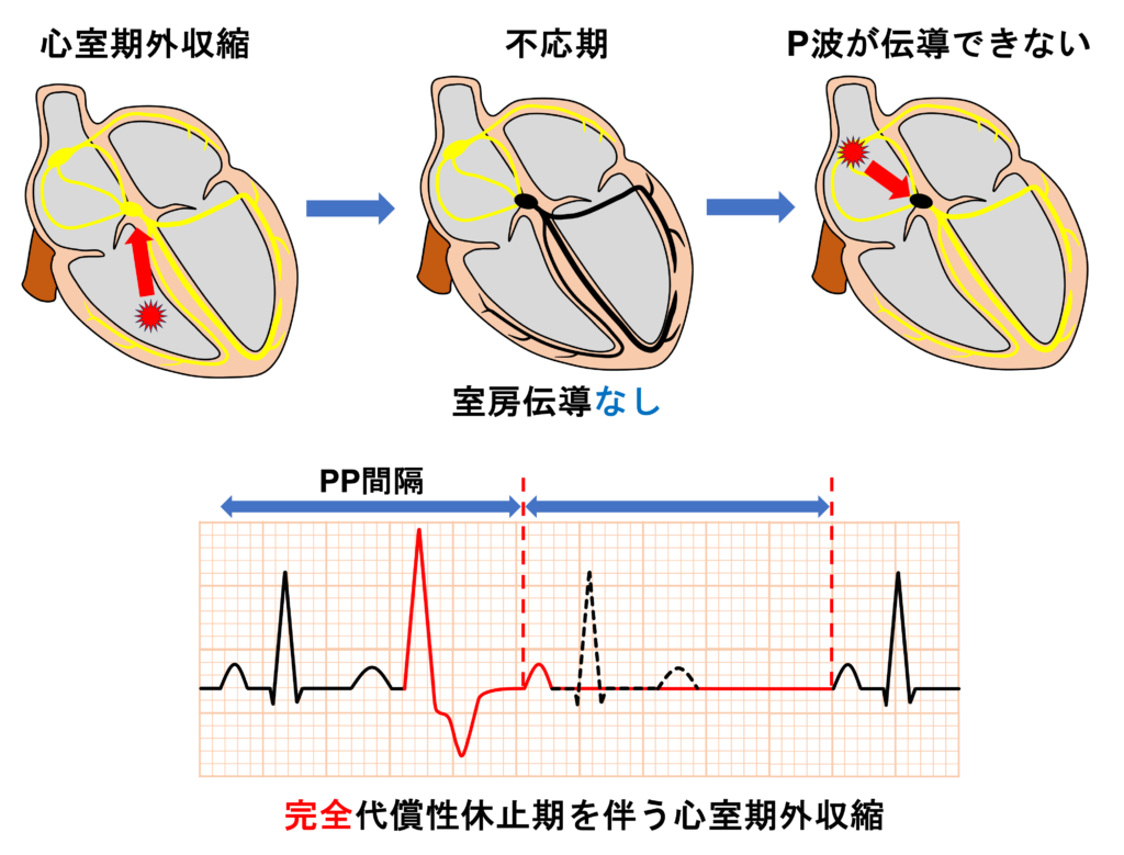 完全代償性休止期(fully compensatory pause)