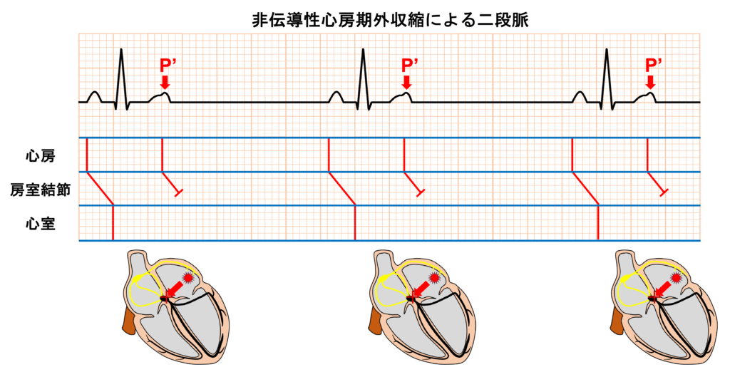 洞性徐脈(sinus bradycardia)