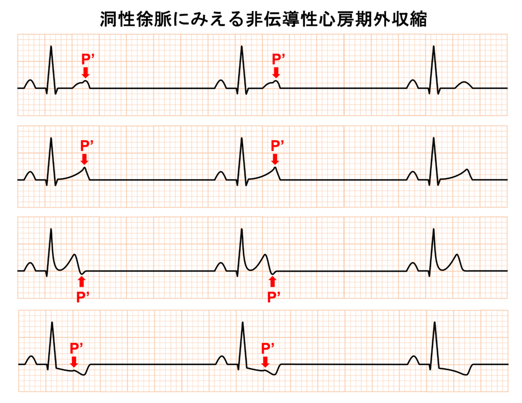 洞性徐脈(sinus bradycardia)