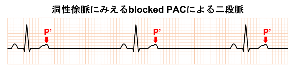 非伝導性心房期外収縮(blocked PAC)