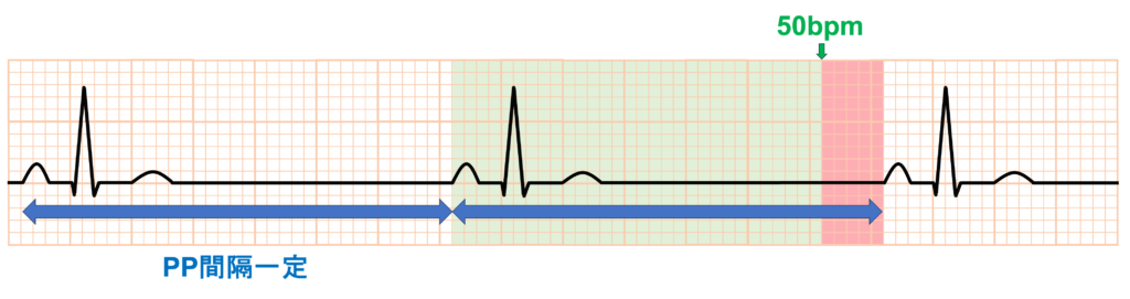 洞性徐脈(sinus bradycardia)
