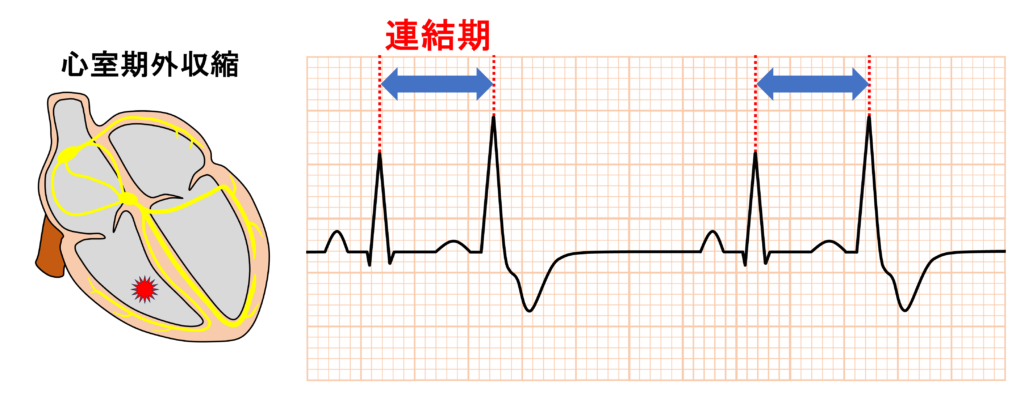 二段脈(bigeminy)