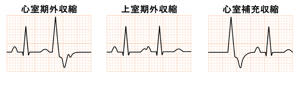 二段脈(bigeminy)