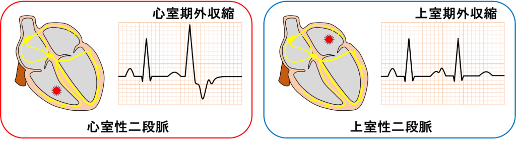 二段脈(bigeminy)