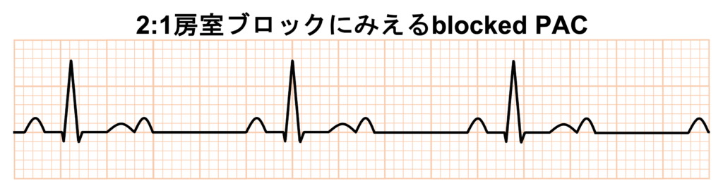 非伝導性心房期外収縮(blocked PAC)