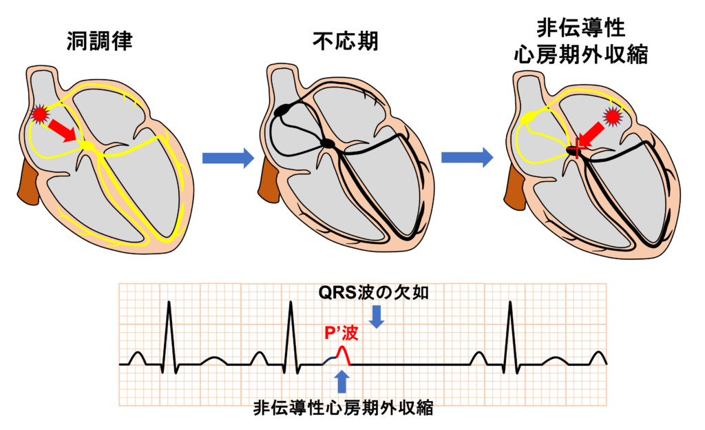 上室期外収縮(Supraventricular premature contraction：SVC)