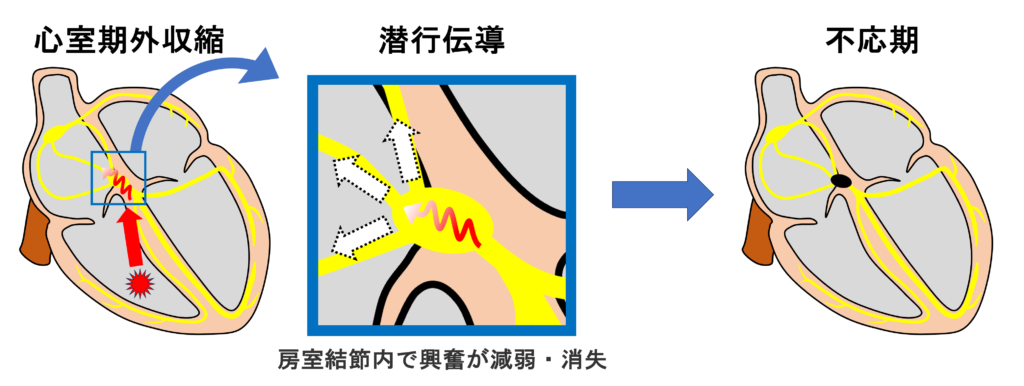 潜行伝導(concealed conduction)