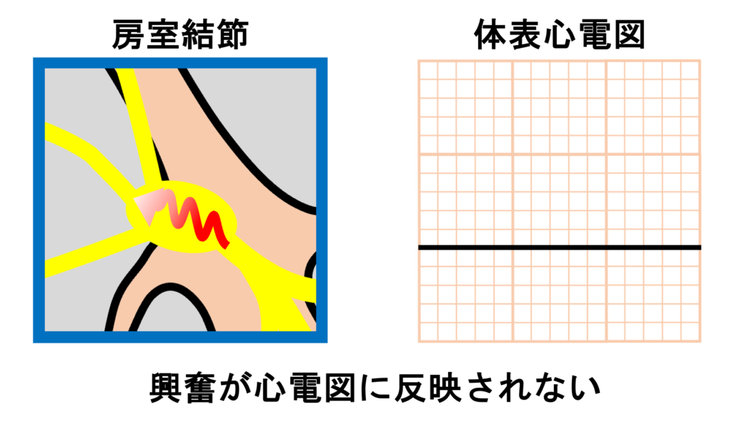 潜行伝導(concealed conduction)