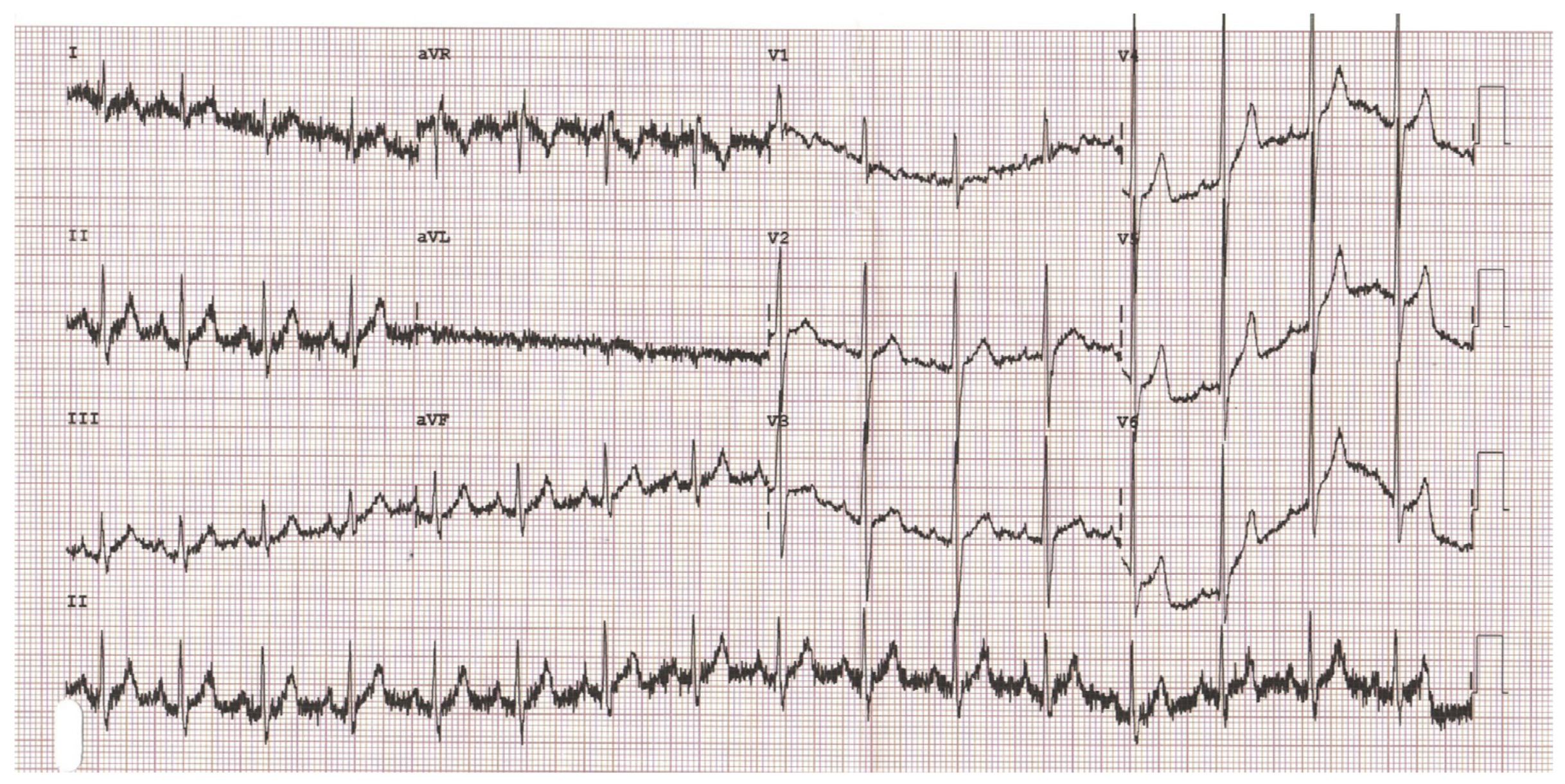 筋電図(electromyogram)