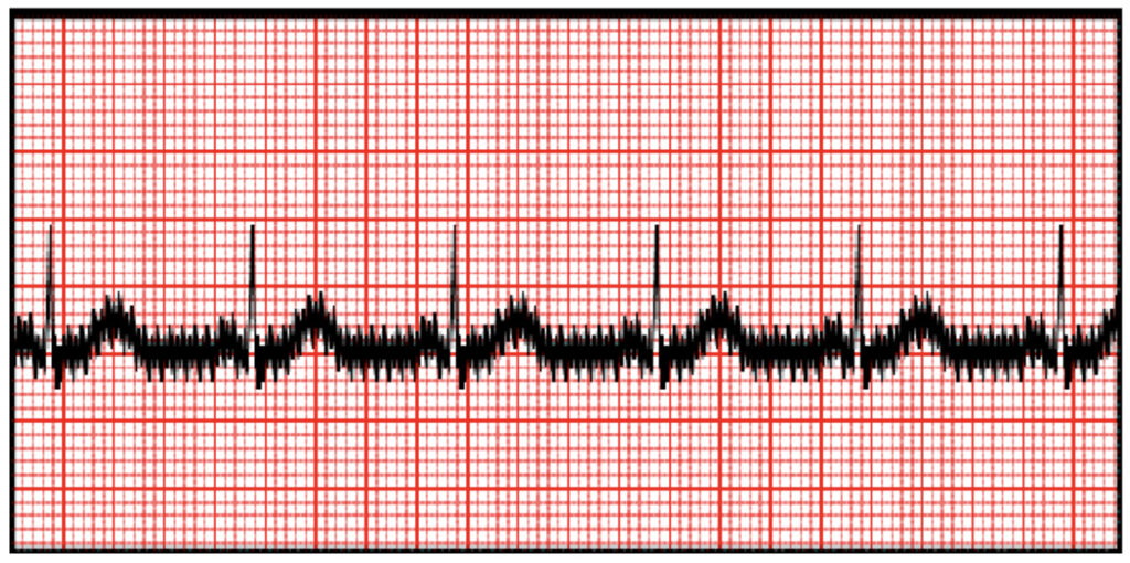 交流障害(powerline interference, hum)