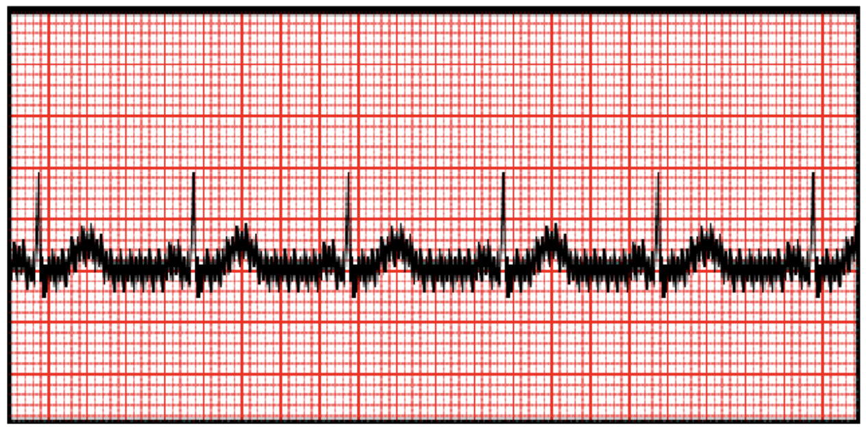 交流障害(powerline interference, hum)