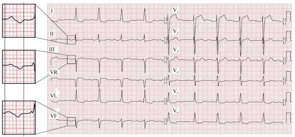 心房間ブロック(Interatrial Block：IAB)