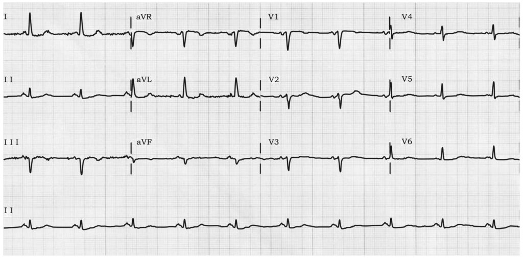 心房間ブロック(Interatrial Block：IAB)