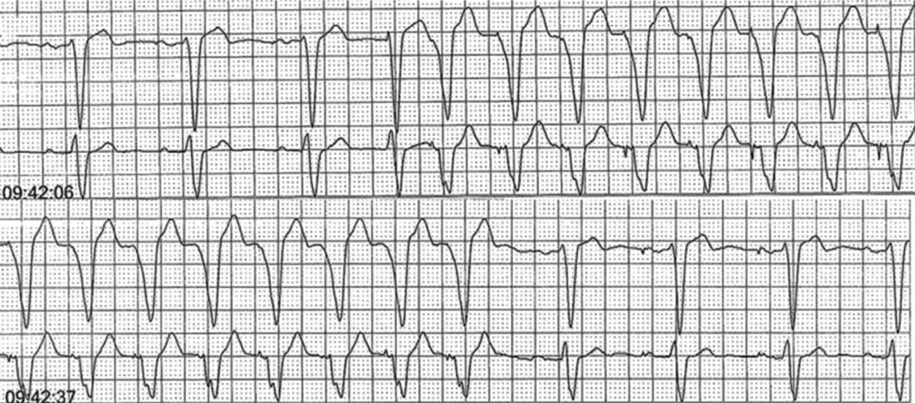 非持続性心室頻拍(Non-sustained ventricular tachycardia: NSVT)