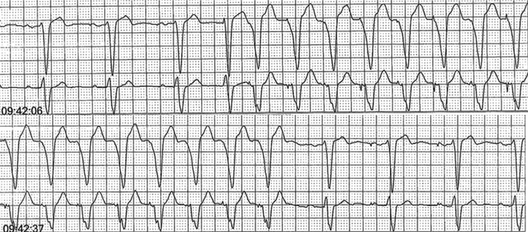 非持続性心室頻拍(Non-sustained ventricular tachycardia: NSVT)