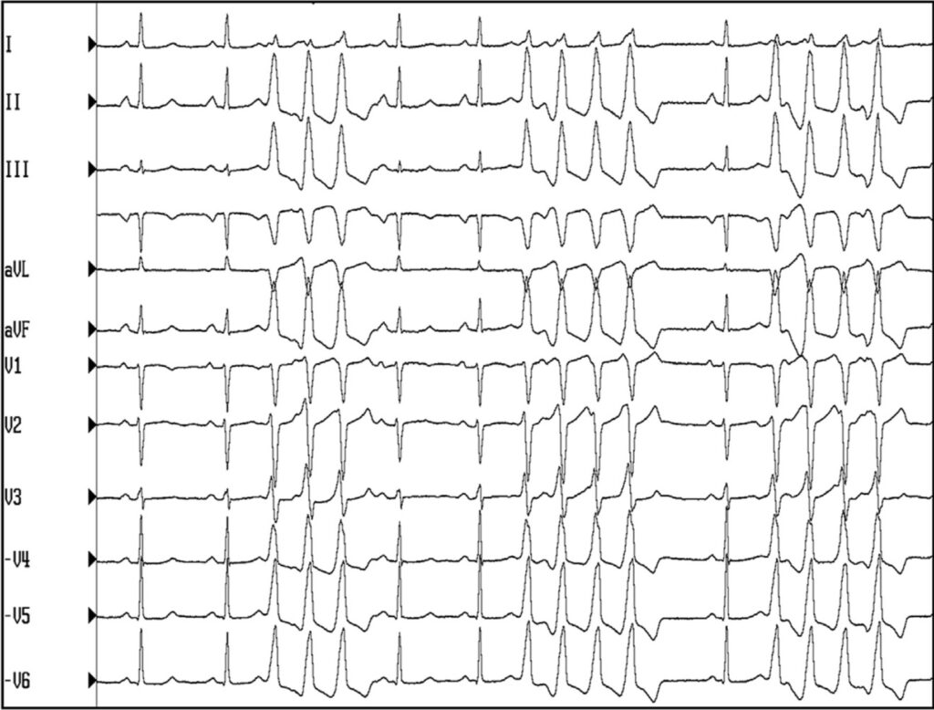 非持続性心室頻拍(Non-sustained ventricular tachycardia: NSVT)