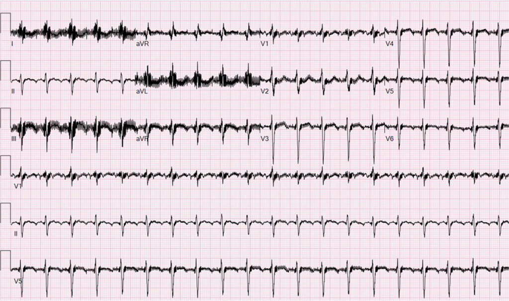 左室補助人工心臓(left ventricular assist device:LVAD)