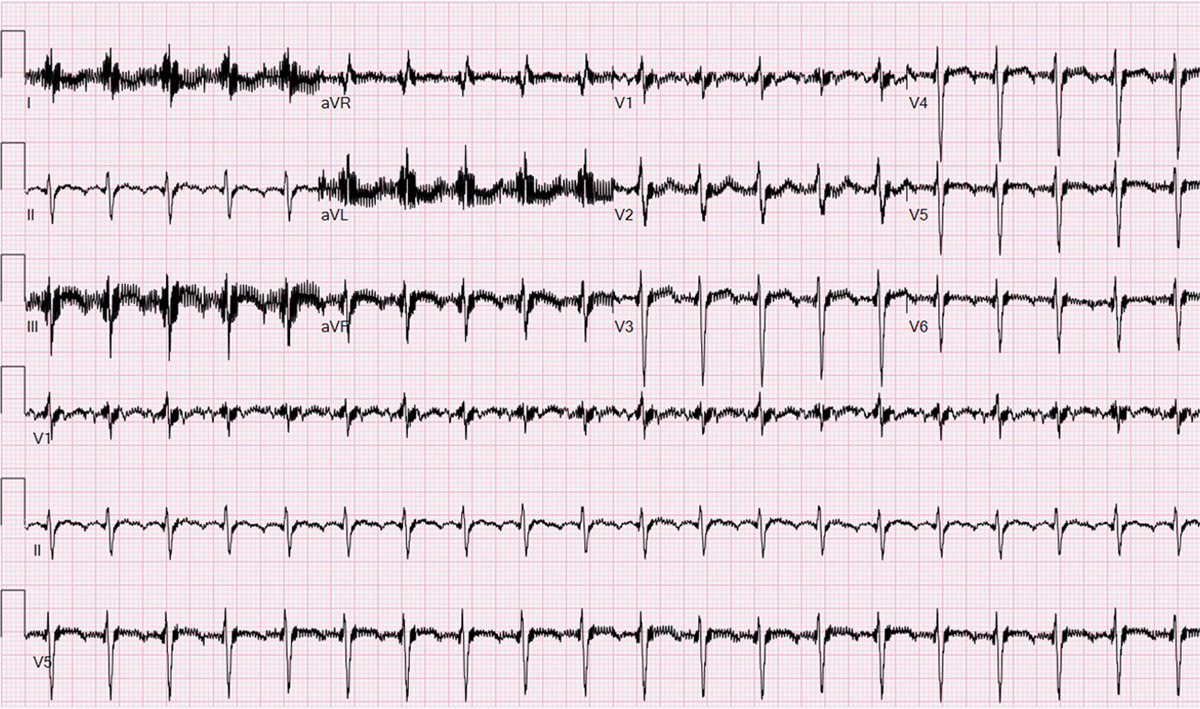 left ventricular assist device