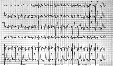 筋電図(electromyogram)