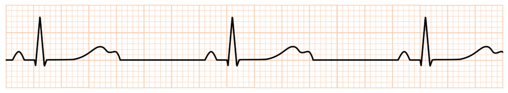 2：1房室ブロック(2：1 atrioventricular block)