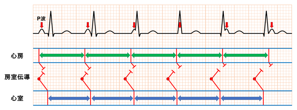 等頻度房室解離(isorhythmic atrioventricular dissociation)