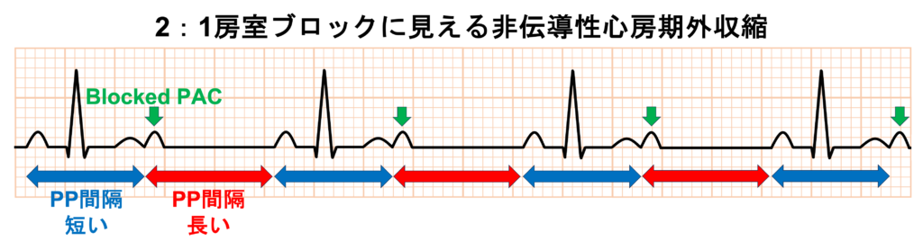 2：1房室ブロック(2：1 atrioventricular block)