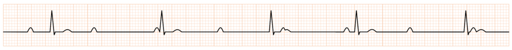 高度房室ブロック(advanced atrioventricular block)