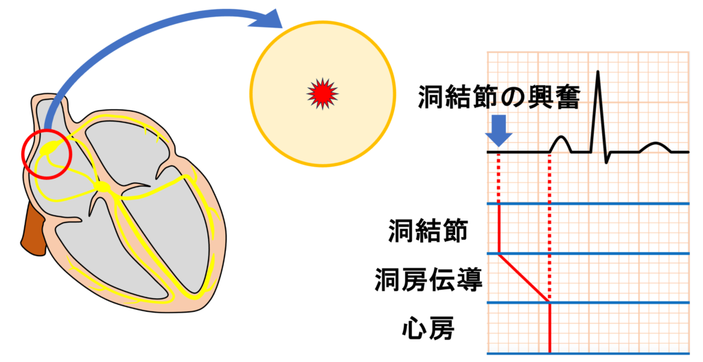 洞房ブロック(sinoatrial block)