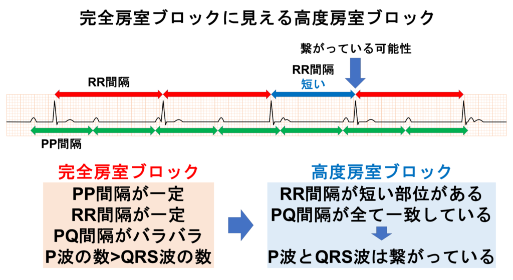 高度房室ブロック(advanced atrioventricular block)
