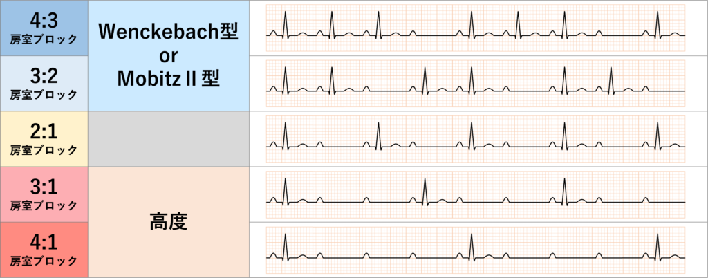 高度房室ブロック(advanced atrioventricular block)