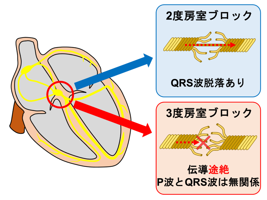 高度房室ブロック(advanced atrioventricular block)