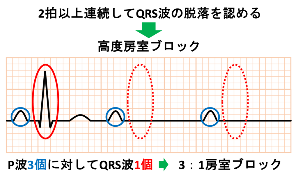 高度房室ブロック(advanced atrioventricular block)
