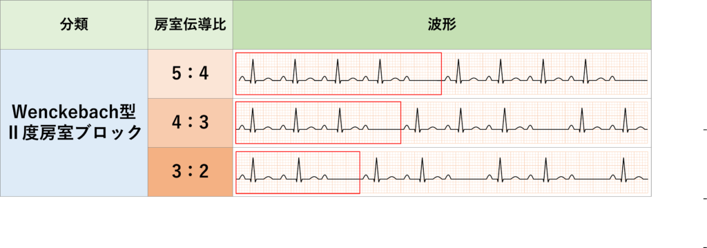 Wenckebach型Ⅱ度房室ブロック(Wenckebach second degree atrioventricular block)