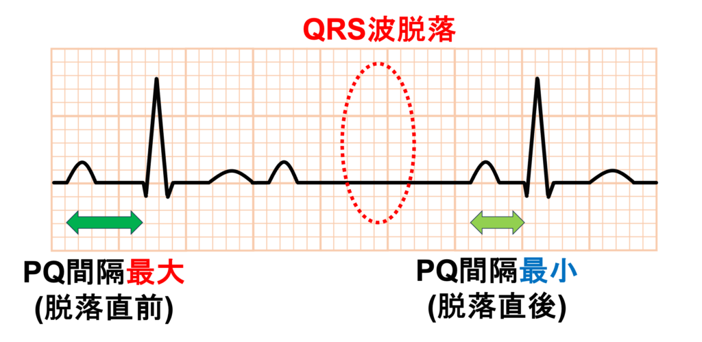 Wenckebach型Ⅱ度房室ブロック(Wenckebach second degree atrioventricular block)